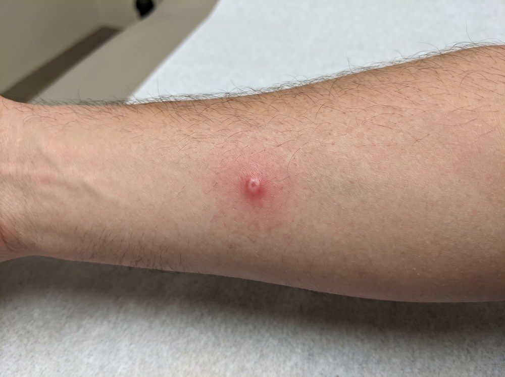 Close up of a fresh deer fly bite showing a raised red welt with a small central puncture and mild surrounding swelling