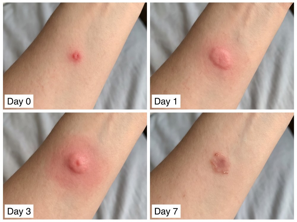 Labeled side by side comparison photo of a deer fly bite next to a horse fly bite showing differences in welt size and appearance